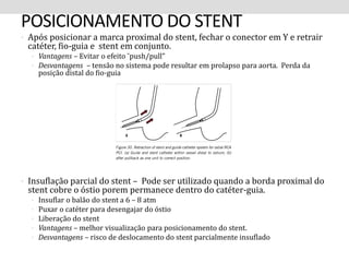 POSICIONAMENTO DO STENT 
• Após posicionar a marca proximal do stent, fechar o conector em Y e retrair 
catéter, fio-guia e stent em conjunto. 
• Vantagens – Evitar o efeito ˜push/pull” 
• Desvantagens – tensão no sistema pode resultar em prolapso para aorta. Perda da 
posição distal do fio-guia 
• Insuflação parcial do stent – Pode ser utilizado quando a borda proximal do 
stent cobre o óstio porem permanece dentro do catéter-guia. 
• Insuflar o balão do stent a 6 – 8 atm 
• Puxar o catéter para desengajar do óstio 
• Liberação do stent 
• Vantagens – melhor visualização para posicionamento do stent. 
• Desvantagens – risco de deslocamento do stent parcialmente insuflado 
 