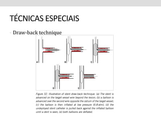 TÉCNICAS ESPECIAIS 
• Draw-back technique 
 