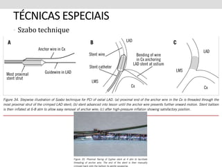 TÉCNICAS ESPECIAIS 
• Szabo technique 
 
