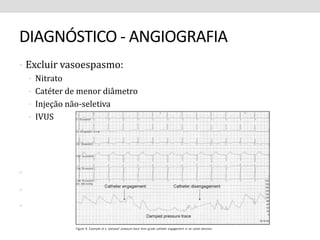 DIAGNÓSTICO - ANGIOGRAFIA 
• Excluir vasoespasmo: 
• Nitrato 
• Catéter de menor diâmetro 
• Injeção não-seletiva 
• IVUS 
• 
• 
• 
 