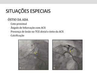 SITUAÇÕES ESPECIAIS 
• ÓSTIO DA ADA 
• Coto proximal 
• Ângulo de bifurcação com ACX 
• Presença de lesão no TCE distal e óstio da ACX 
• Calcificação 
 