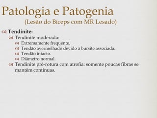 Patologia e Patogenia
(Lesão do Bíceps com MR Lesado)
 Tendinite:
 Tendinite moderada:
 Extremamente freqüente.
 Tendão avermelhado devido à bursite associada.
 Tendão intacto.
 Diâmetro normal.
 Tendinite pré-rotura com atrofia: somente poucas fibras se
mantêm contínuas.
 