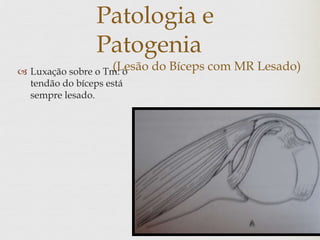 Patologia e
Patogenia
(Lesão do Bíceps com MR Lesado) Luxação sobre o Tm: o
tendão do bíceps está
sempre lesado.
 