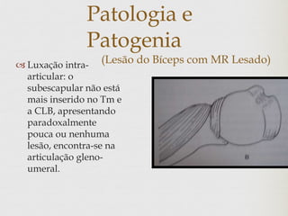 Patologia e
Patogenia
(Lesão do Bíceps com MR Lesado) Luxação intra-
articular: o
subescapular não está
mais inserido no Tm e
a CLB, apresentando
paradoxalmente
pouca ou nenhuma
lesão, encontra-se na
articulação gleno-
umeral.
 