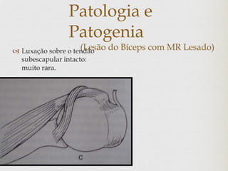 Patologia e
Patogenia
(Lesão do Bíceps com MR Lesado) Luxação sobre o tendão
subescapular intacto:
muito rara.
 