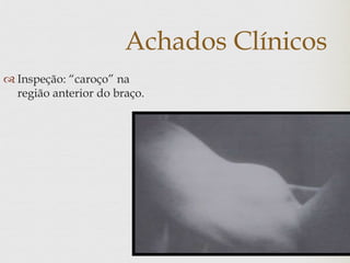 Achados Clínicos
 Inspeção: “caroço” na
região anterior do braço.
 