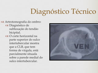 Diagnóstico Técnico
 Artrotomografia do ombro:
 Diagnóstico de
subluxação do tendão
bicipital.
 O corte horizontal na
parte superior do sulco
intertubercular mostra
que a CLB, que tem
forma de vírgula, está
parcialmente situada
sobre a parede medial do
sulco intertubercular.
 