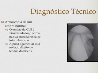 Diagnóstico Técnico
 Artroscopia de um
ombro normal:
 O tendão da CLB é
visualizado logo acima
na sua entrada no sulco
intertubercular.
 A polia ligamentar está
no lado direito do
tendão do bíceps.
 
