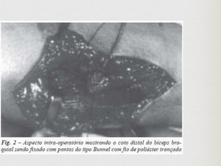 Lesoes proximais do biceps