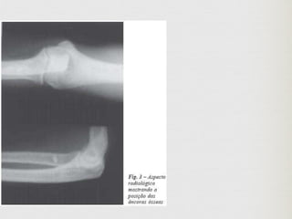 Lesoes proximais do biceps