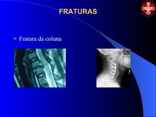 FRATURAS


   Fratura da coluna
 
