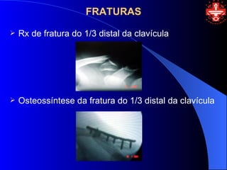 FRATURAS

   Rx de fratura do 1/3 distal da clavícula




   Osteossíntese da fratura do 1/3 distal da clavícula
 
