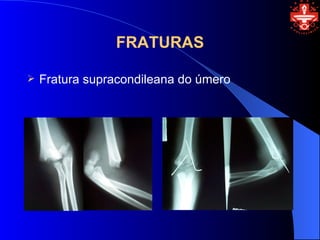 FRATURAS

   Fratura supracondileana do úmero
 
