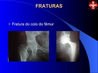 FRATURAS


   Fratura do colo do fêmur
 