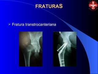 FRATURAS


   Fratura transtrocanteriana
 