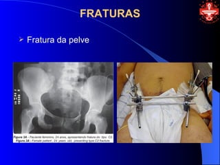 FRATURAS

   Fratura da pelve
 
