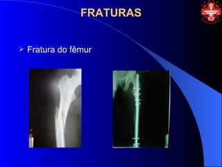 FRATURAS


   Fratura do fêmur
 