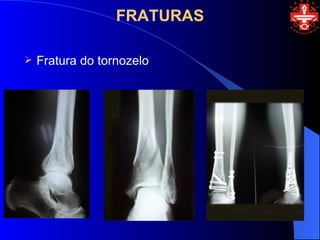 FRATURAS

   Fratura do tornozelo
 