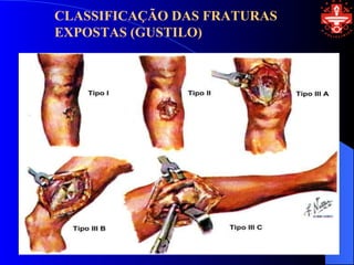 CLASSIFICAÇÃO DAS FRATURAS
EXPOSTAS (GUSTILO)
 