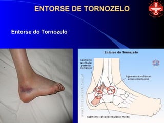 ENTORSE DE TORNOZELO


Entorse do Tornozelo
 