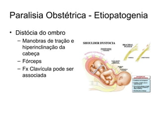 Paralisia Obstétrica - Etiopatogenia Distócia do ombro Manobras de tração e hiperinclinação da cabeça Fórceps Fx Clavícula pode ser associada 
