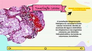A tumefação (degeneração
hidrópica ou vacuolar) é lesão
celular reversível, devido ao
acúmulo de água e eletrólitos
no citoplasma e nas organelas
celulares, por distúrbio
hidroeletrolítico, tornando-as
volumosas, tumefeitas.
Tumefação Celular Alteração morfológicas nas células
e nos tecidos lesados
 