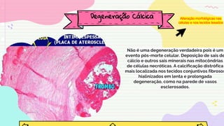 Não é uma degeneração verdadeira pois é um
evento pós-morte celular. Deposição de sais de
cálcio e outros sais minerais nas mitocôndrias
de células necróticas. A calcificação distrófica
mais localizada nos tecidos conjuntivos fibrosos
hialinizados em lenta e prolongada
degeneração, como na parede de vasos
esclerosados.
Degeneração Cálcica Alteração morfológicas nas
células e nos tecidos lesados
 