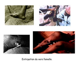 Extirpation du vers femelle
 