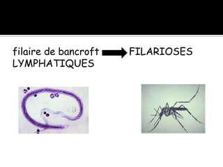filaire de bancroft FILARIOSES
LYMPHATIQUES
 