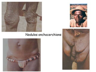 Nodules onchocerchiens
 