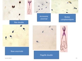 24/01/2025 73
Tête double
Acrosome
anormal
Base anormale
Flagelle double
Restes
cytoplasmiques
 