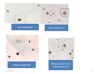 24/01/2025 75
spermatogonie Spermatocyte 1
Cellule épithéliale Polynucléaire (1) et
lymphocyte (2)
 
