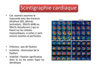 Scintigraphie cardiaque
• Cet examen examine le
  myocarde avec des traceurs
  (thallium 201, dérivés
  technetiés : 99mTc-MIBI ou
  99mTc-Tetrofosmin ) qui se
  fixent sur les cellules
  myocardiques, si celles ci sont
  encore vivantes et perfusées.


• Infarctus : pas de fixation
• Ischémie : diminution de la
  fixation
• Viabilité : fixation significative
  dans la ou les zones hypo ou
  akinétique
 