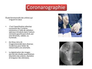 Coronarographie
Étude fonctionnelle des artères qui
    irriguent le cœur


•    C'est l'opacification sélective
    successive des 2 artères
    coronaires à l'aide de cathéters
    spéciaux introduits dans l'ostium
    coronaire gauche puis droit, par
    voie fémorale, radiale, ou
    humérale.

•   On filme (10 à 25
    images/seconde) dans diverses
    incidences pour éviter de
    méconnaître une anomalie.

•   La digitalisation des images
    permet des études quantitatives
    (diamètre des artères, diamètre
    et longueur des sténoses).
 
