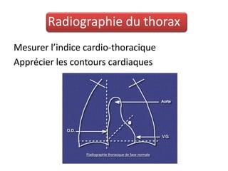 Radiographie du thorax
Mesurer l’indice cardio-thoracique
Apprécier les contours cardiaques
 