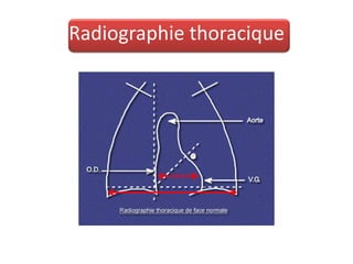Radiographie thoracique
 