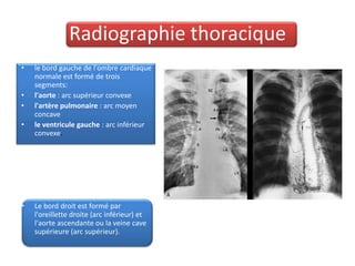 Radiographie thoracique
•   le bord gauche de l'ombre cardiaque
    normale est formé de trois
    segments:
•   l'aorte : arc supérieur convexe
•   l'artère pulmonaire : arc moyen
    concave
•   le ventricule gauche : arc inférieur
    convexe.




•   Le bord droit est formé par
    l'oreillette droite (arc inférieur) et
    l'aorte ascendante ou la veine cave
    supérieure (arc supérieur).
 