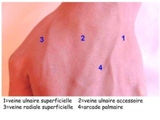 1=veine ulnaire superficielle 2=veine ulnaire accessoire
3=veine radiale superficielle 4=arcade palmaire
 