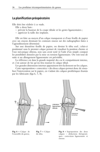 Les protheses tricompartimentaires_du_genou_de_premiere_ intention | PDF