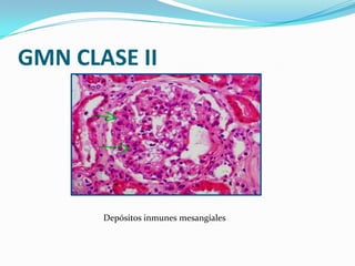 GMN CLASE II




       Depósitos inmunes mesangiales
 