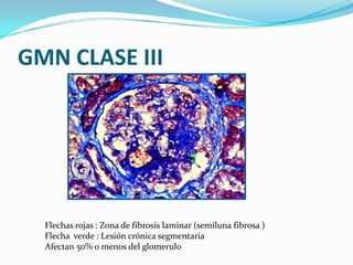 GMN CLASE III




  Flechas rojas : Zona de fibrosis laminar (semiluna fibrosa )
  Flecha verde : Lesión crónica segmentar...