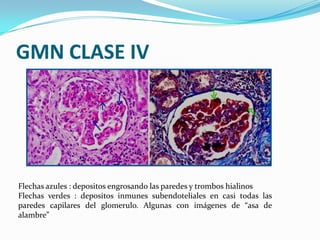 GMN CLASE IV




Flechas azules : depositos engrosando las paredes y trombos hialinos
Flechas verdes : depositos inmunes s...