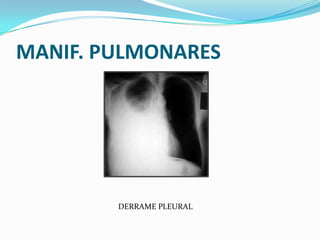 MANIF. PULMONARES




        DERRAME PLEURAL
 