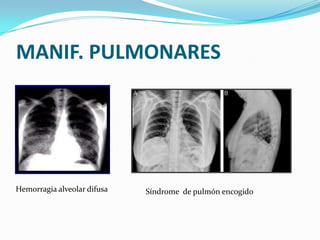 MANIF. PULMONARES




Hemorragia alveolar difusa   Síndrome de pulmón encogido
 