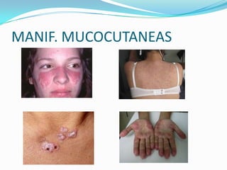 MANIF. MUCOCUTANEAS
 