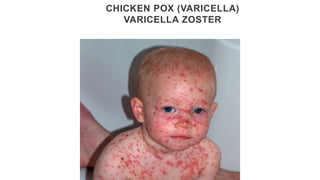 CHICKEN POX (VARICELLA)
VARICELLA ZOSTER
 