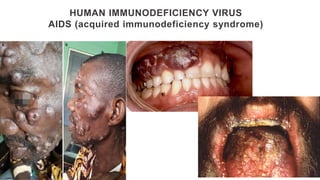 HUMAN IMMUNODEFICIENCY VIRUS
AIDS (acquired immunodeficiency syndrome)
 
