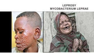 LEPROSY
MYCOBACTERIUM LEPRAE
 