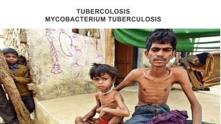 TUBERCOLOSIS
MYCOBACTERIUM TUBERCULOSIS
 