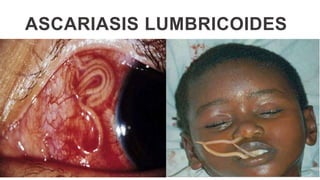 ASCARIASIS LUMBRICOIDES
 